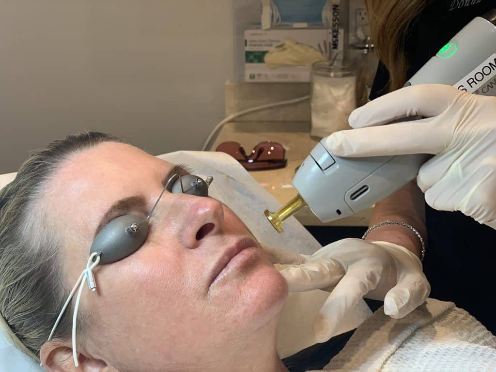 ipl photofacials 6