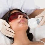 laser acne treatment 02
